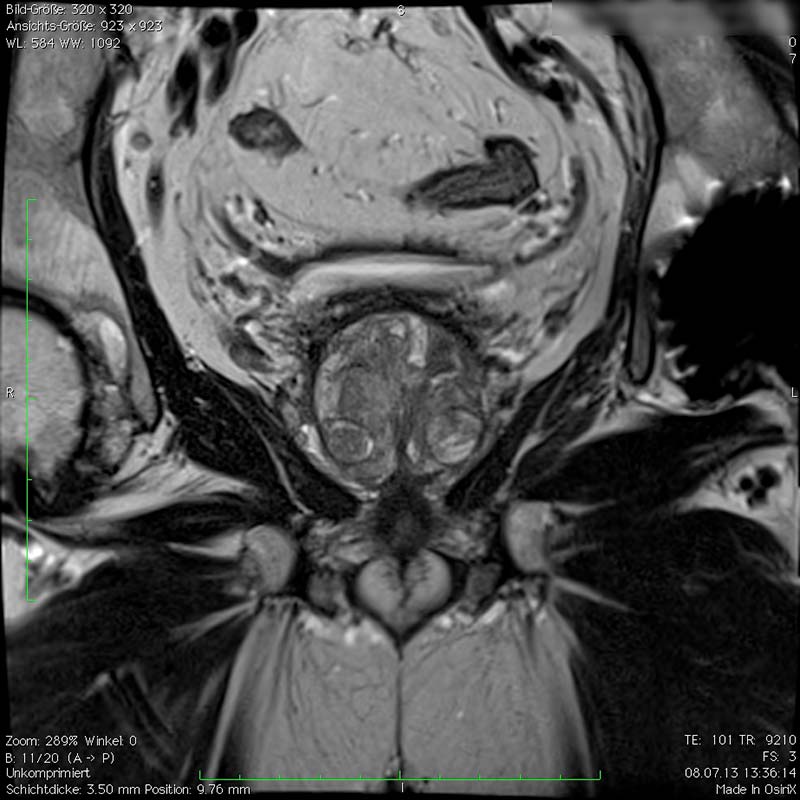 mri prostatakarzinom